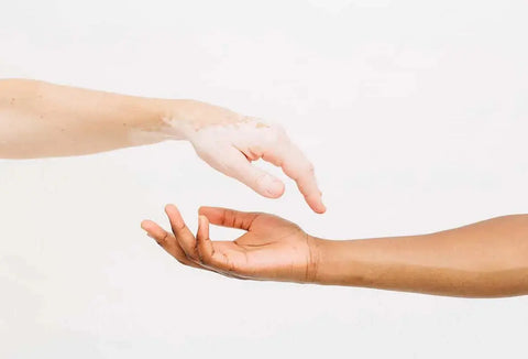 Two arms reaching toward each other, one with vitiligo, symbolizing skin diversity and microbiome balance